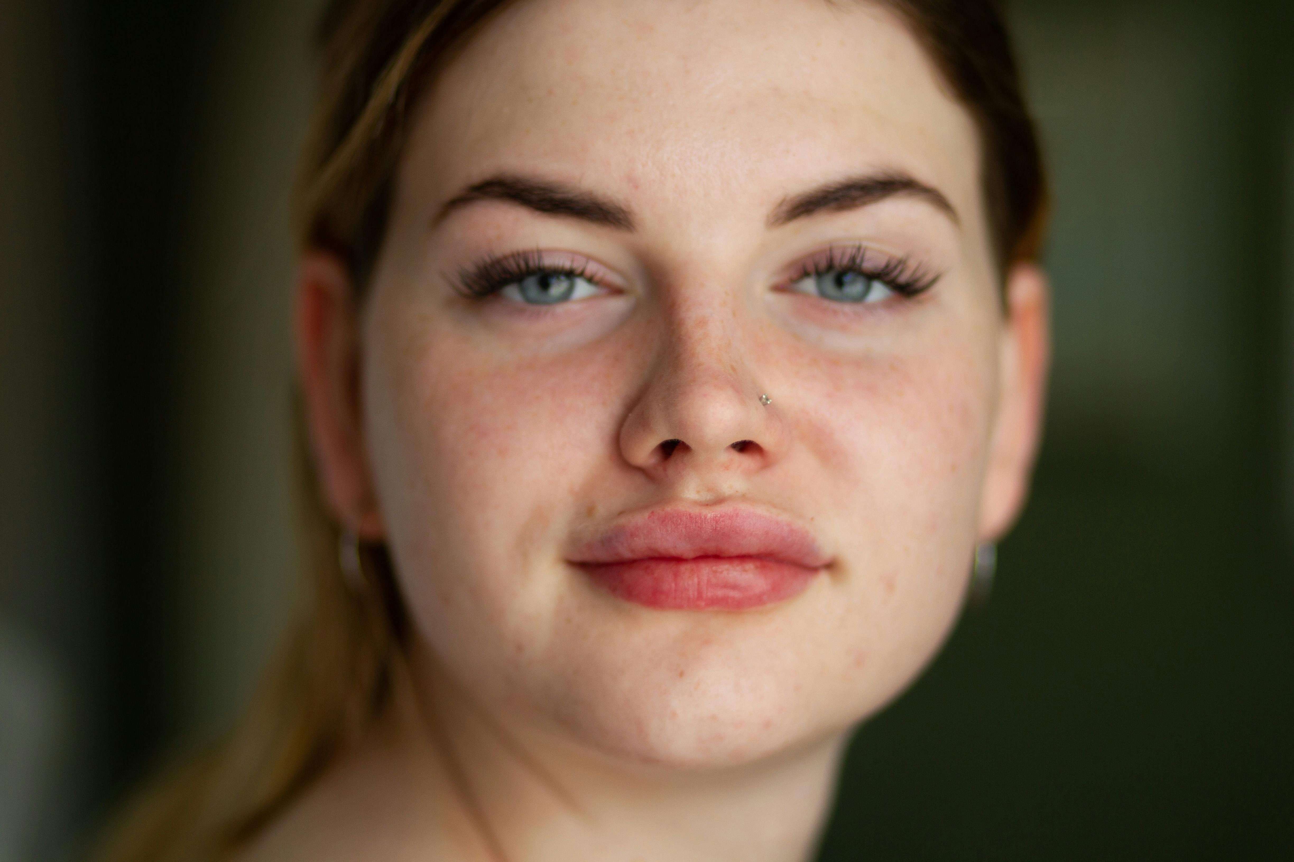 Chin & Cheek Augmentation in Albania: A Guide to Facial Implants