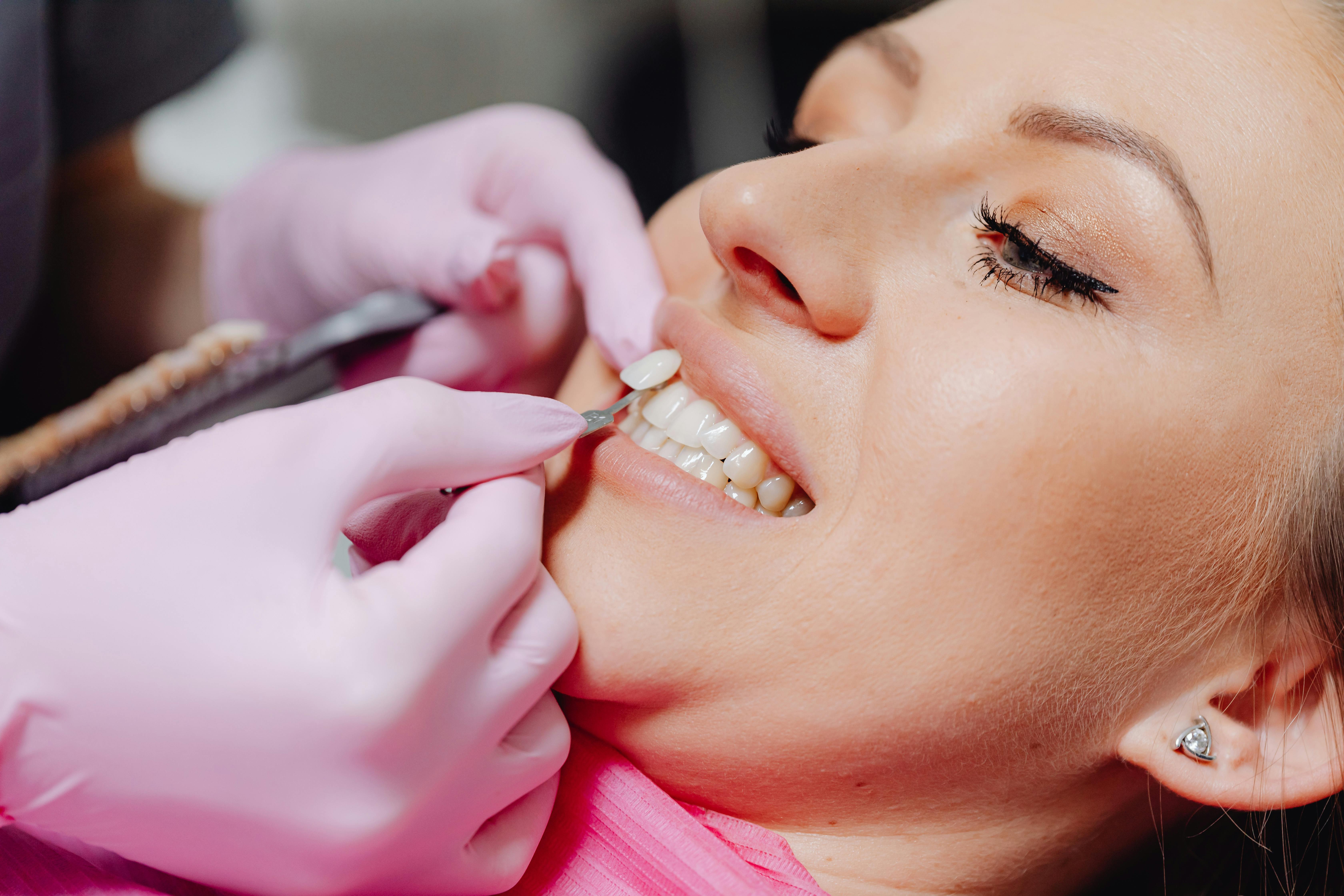Porcelain Veneers in Albania: A Guide to a Perfect Smile